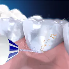 La canule AquaCare Série 4 nettoie les espaces interdentaires et les gencives, et cible les résidus.	 