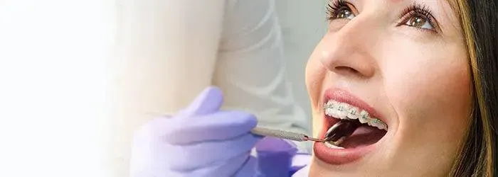 Visites de contrôle pour votre appareil dentaire article banner