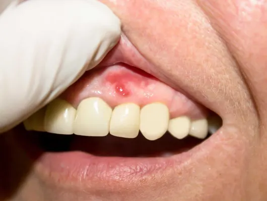 Une main gantée soulevant la lèvre supérieure d’un homme pour révéler un bouton sur sa gencive
