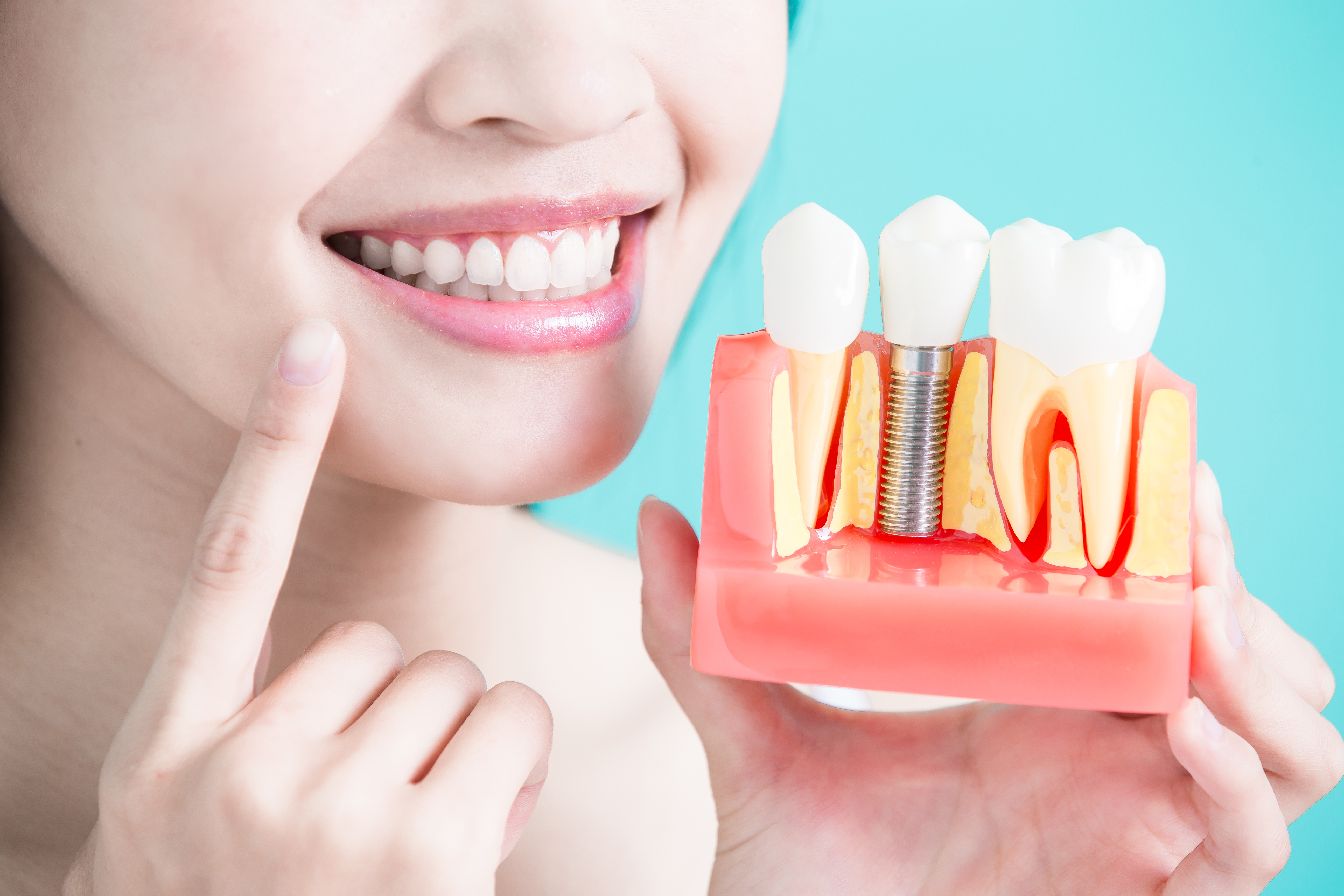 Implants dentaires et maladies des gencives : Ce qu’il vous faut savoir article link