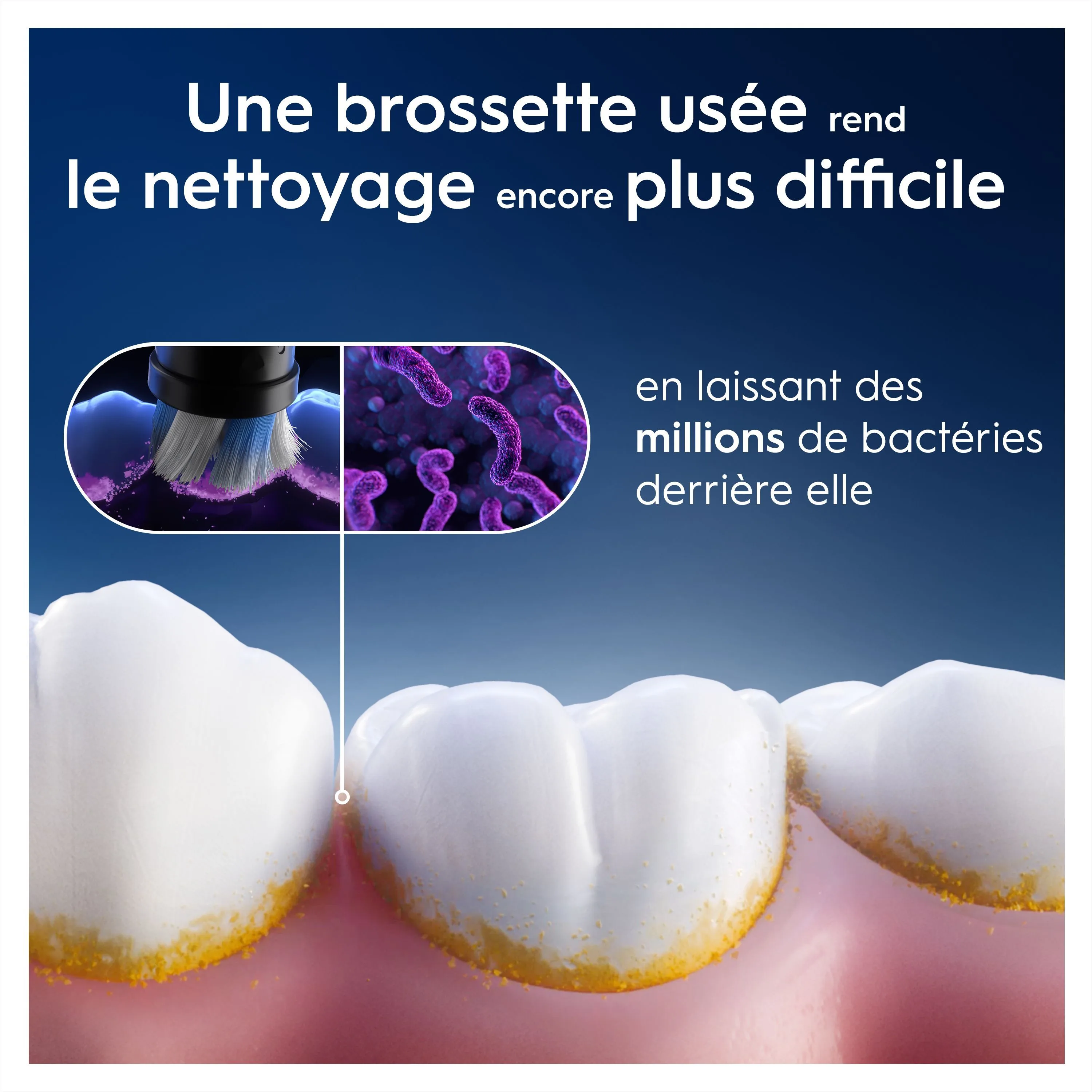 Une brosse à dents usagée dépose des millions de bactéries, rendant le nettoyage plus difficile, illustré par une dent sale.