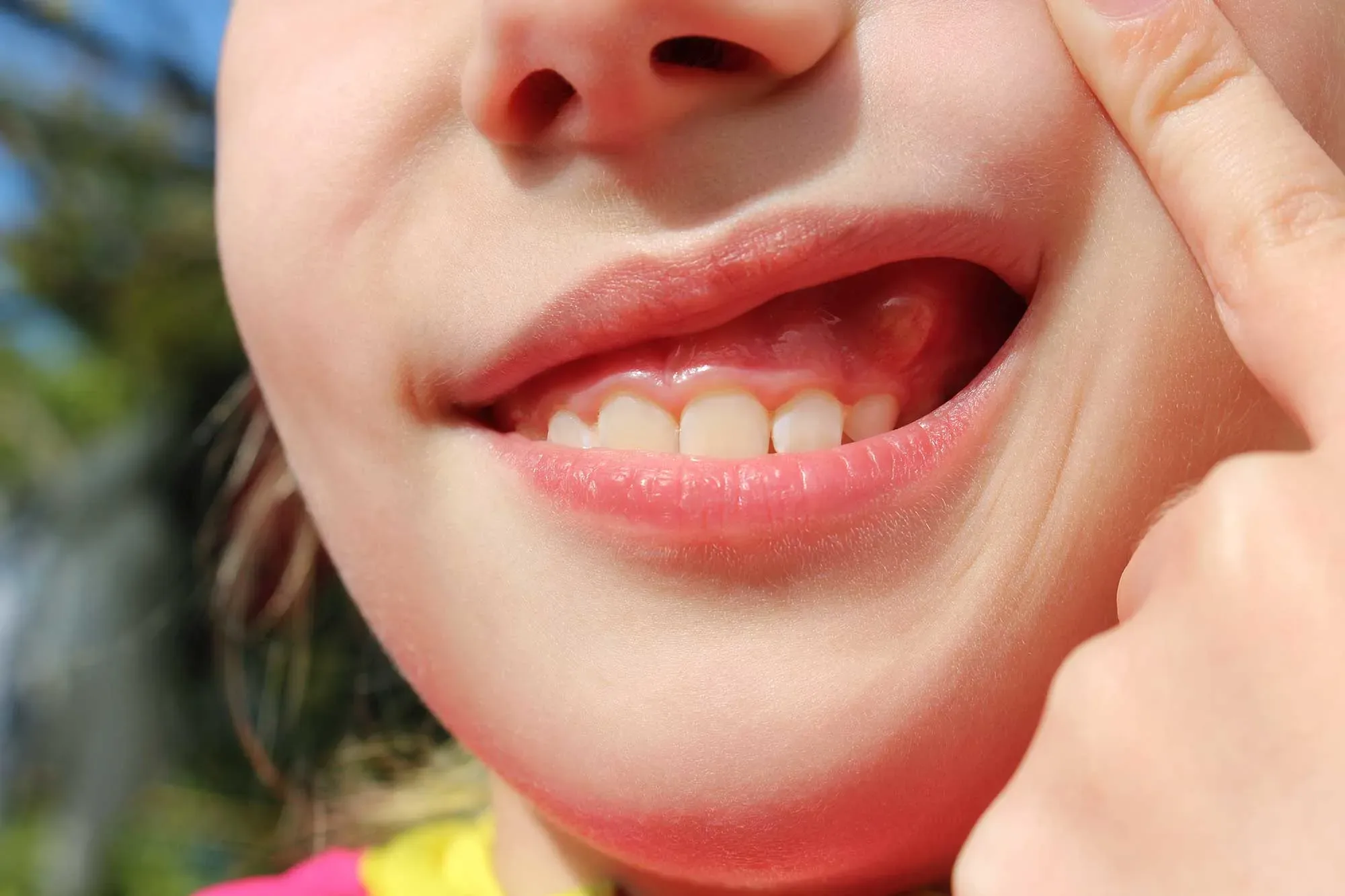 Dent abcédée : causes, symptômes, traitements et prévention