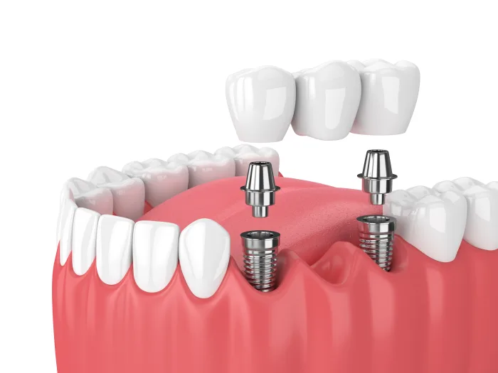 Implantes Dentários: O que esperar