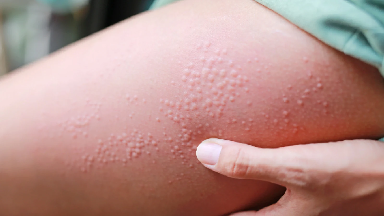 How to deal with rashes around the intimate area?