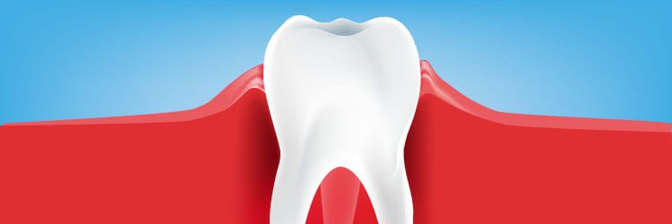 Tandkødsbetændelse: symptomer, årsager og behandling article banner