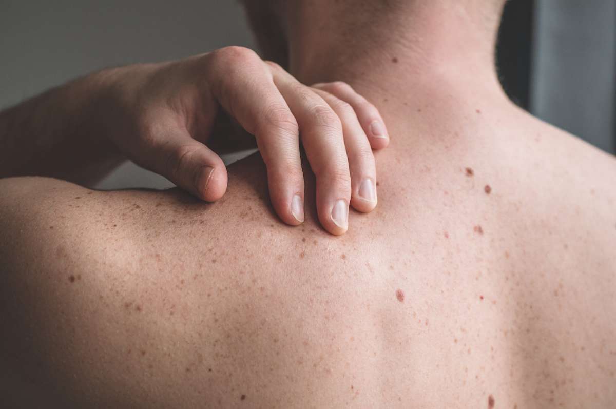 10 Skin Cancer Symptoms To Look Out For