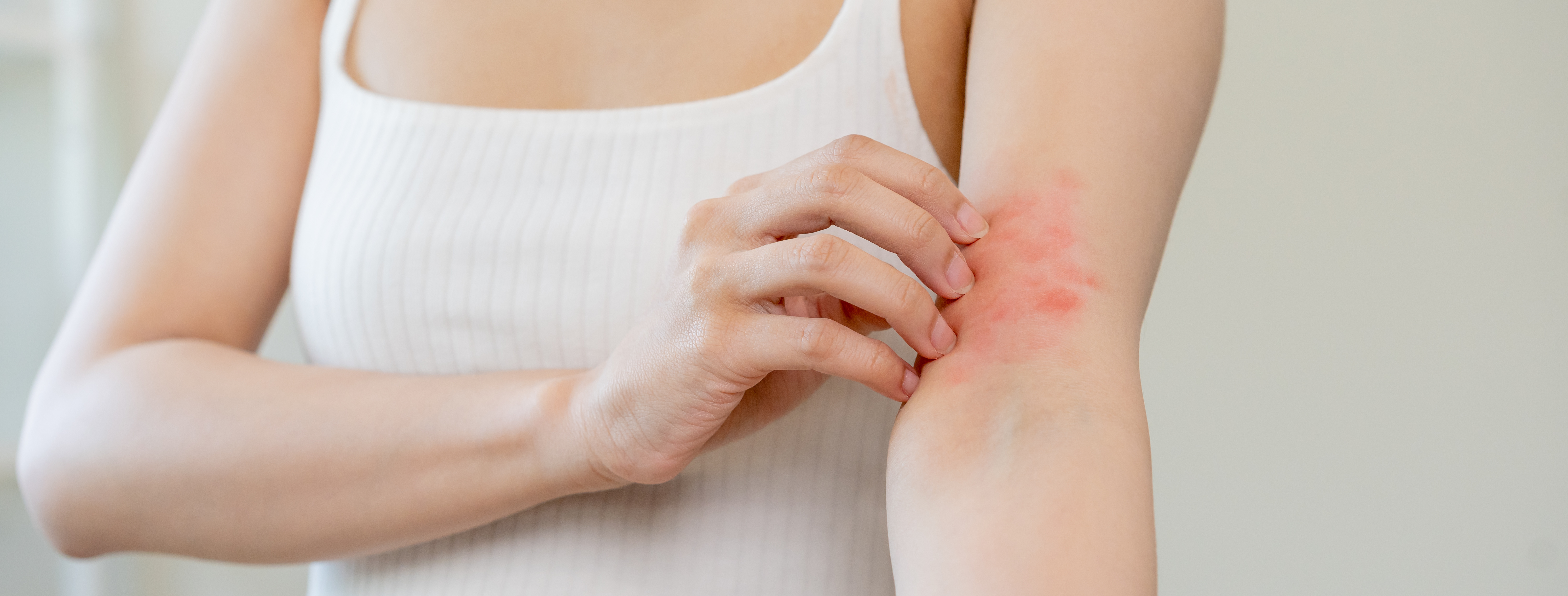 5 Recommended Heat Rash Treatments for Fast Relief