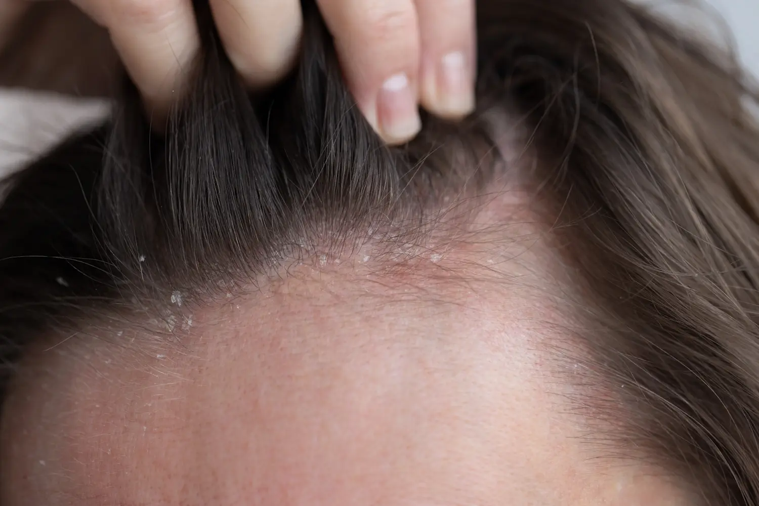 flaking, irritated scalp