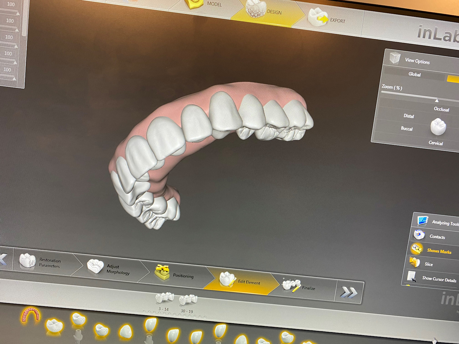 inLab CAD design full arch all on 4 give me teeth