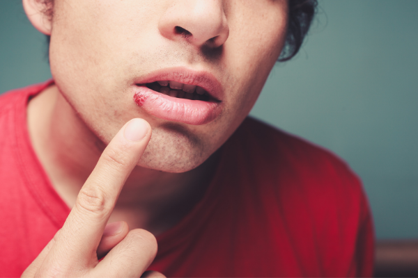 I get cold sores. Can I pass these onto others if I give someone else oral sex?