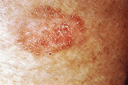 Reddish area is squamous cell skin cancer