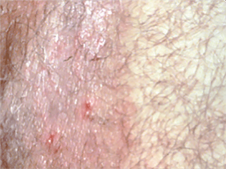 A ringworm infection in the groin