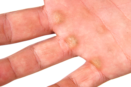 Palm of hand with calluses