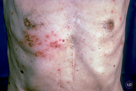 Blistering shingles rash on a man's chest