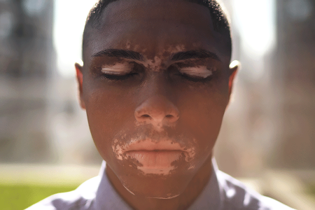 Vitiligo on face