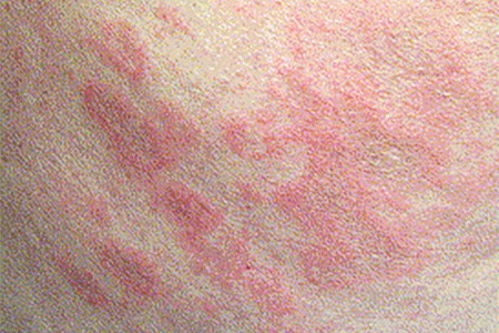 Hives due to radiation therapy.