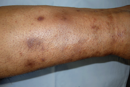 Spots on leg of person with diabetes called diabetic dermopathy