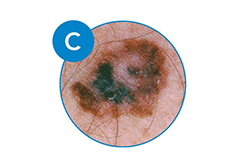 Public>Diseases>Skin-cancer>Types>Melanoma>Symptoms>Color