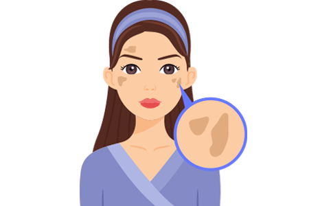 Illustration of woman with age spots on her face