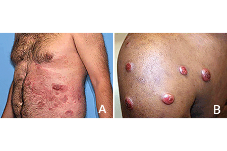 Tumors due to cutaneous T-cell lymphoma can develop when you have other lesions or appear alone