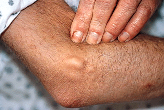 Kidney disease: 11 ways it can affect your skin