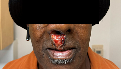 Patient with lesion extending from nose to lip as cutaneous manifestation of cocaine use.
