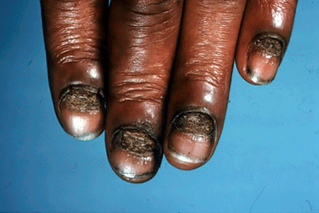Painful, crumbling nails due to alopecia areata