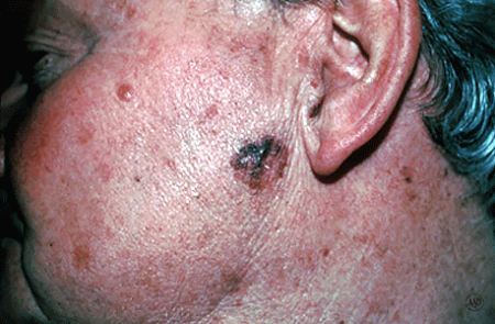 Close-up of a melanoma that looks like an age spot