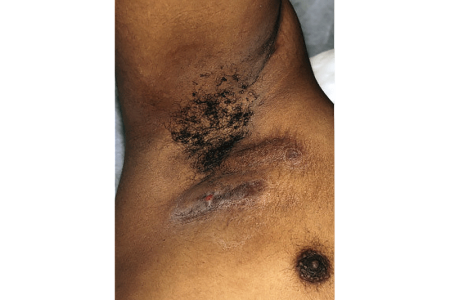Hidradenitis suppurativa scars near armpit