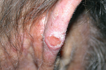 Round growth on ear is squamous cell skin cancer
