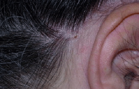 Scalp after treating scalp psoriasis with a biologic