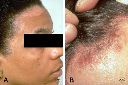 Pictures of seborrheic dermatitis on the scalp