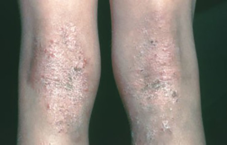 Atopic dermatitis: thickened skin on the back of her knees 