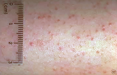 Keratosis pilaris on the skin