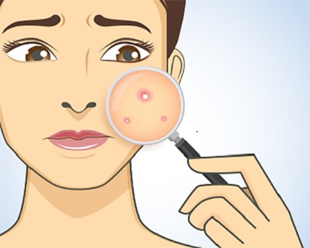 Illustration of woman with blemishes