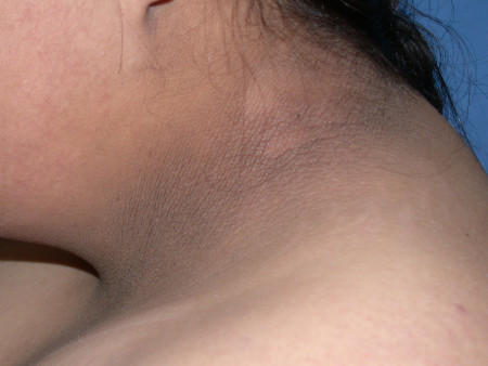 Acanthosis nigricans on the neck