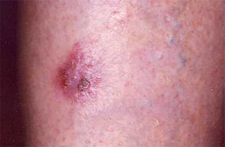 stasis dermatitis sore