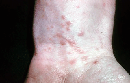 Lichen planus on the wrist