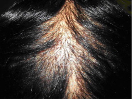 scalp with alopecia scarring