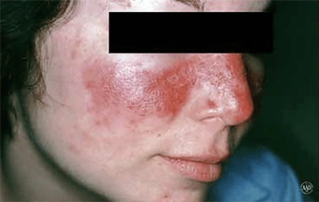Lupus butterfly rash on nose and cheeks of the face