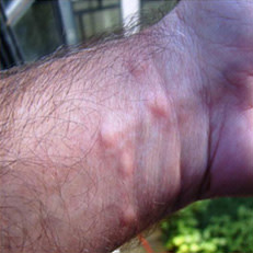 Image for DWII of fire ant stings on the skin