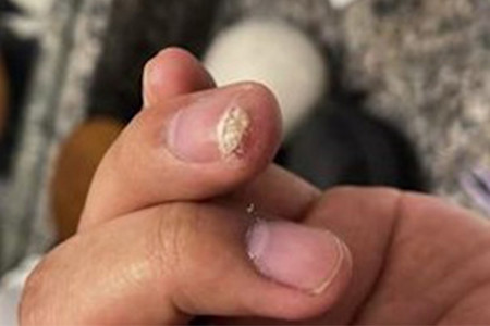 What looks like a wart growing from this patient’s nail is really a type of skin cancer called squamous cell carcinoma | American Academy of Dermatology (AAD).