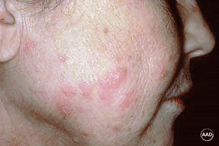 Lupus rash triggered by indoor lighting