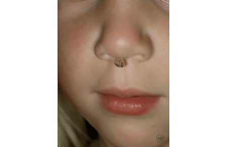 A wart under a child's nose