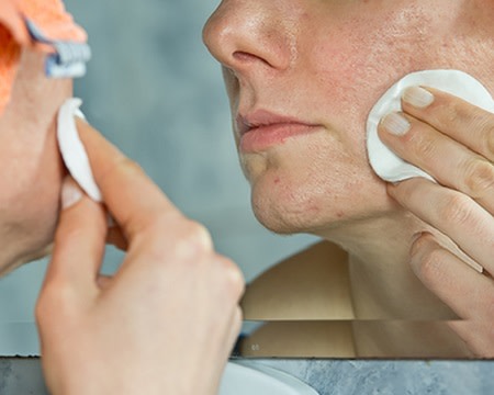 Woman treating acne pustules