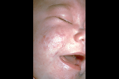 Baby with acne