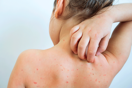 Girl scratching itchy chickenpox rash on her back