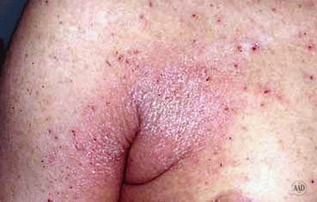Crusted scabies on a man's arm and chest