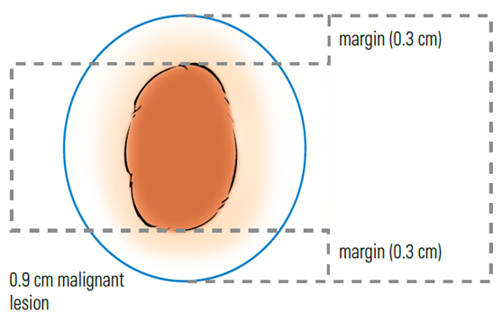 Illustration of excision, malignant lesion of the nose