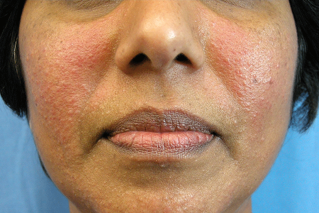 Dry, red skin on cheeks caused by rosacea